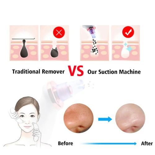 Blackhead Removal Suction Tool - Electric Pore Vacuum Cleaner